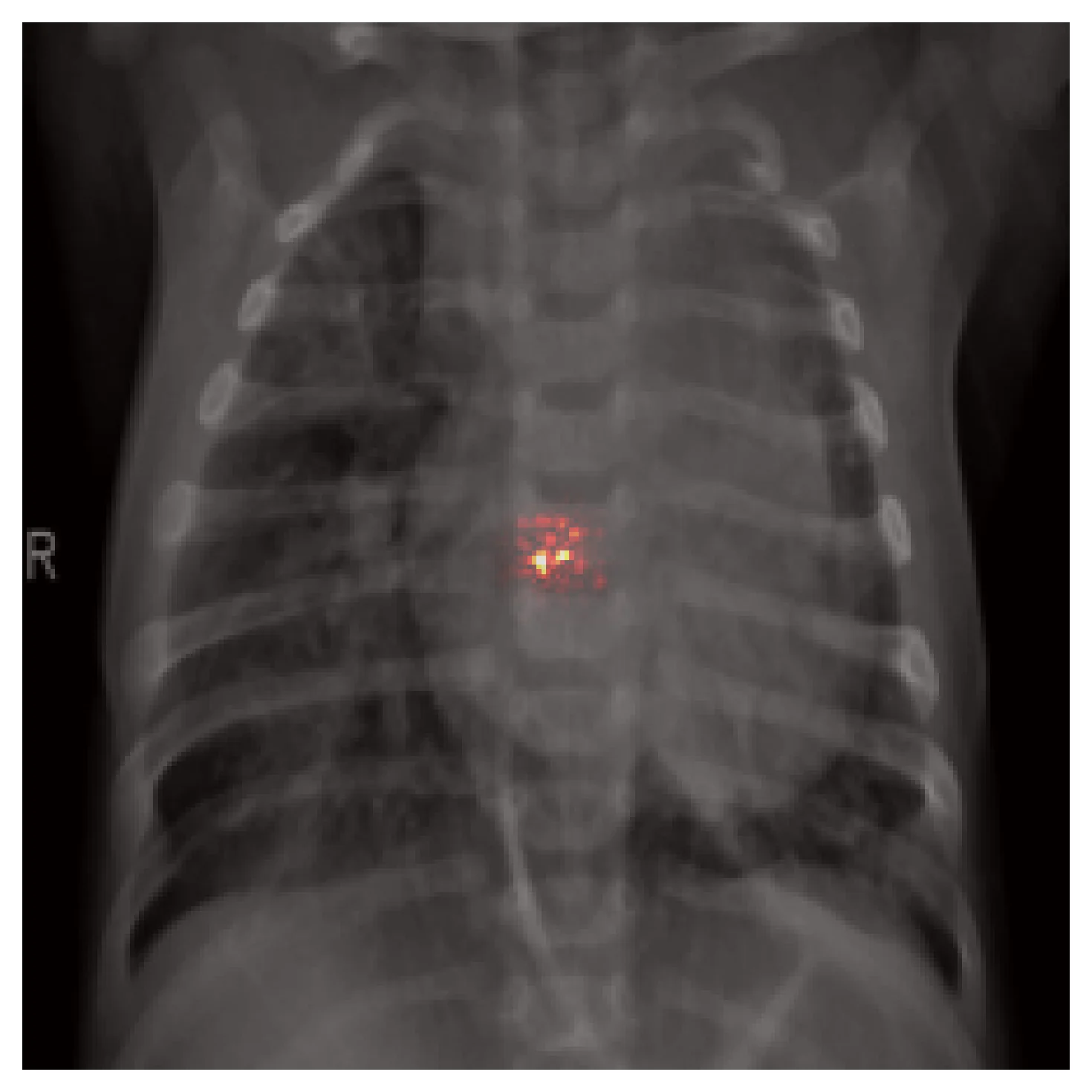 Effective receptive field at layer1 of ResNet50, shown as a small concentrated dot near the center of the chest radiograph.