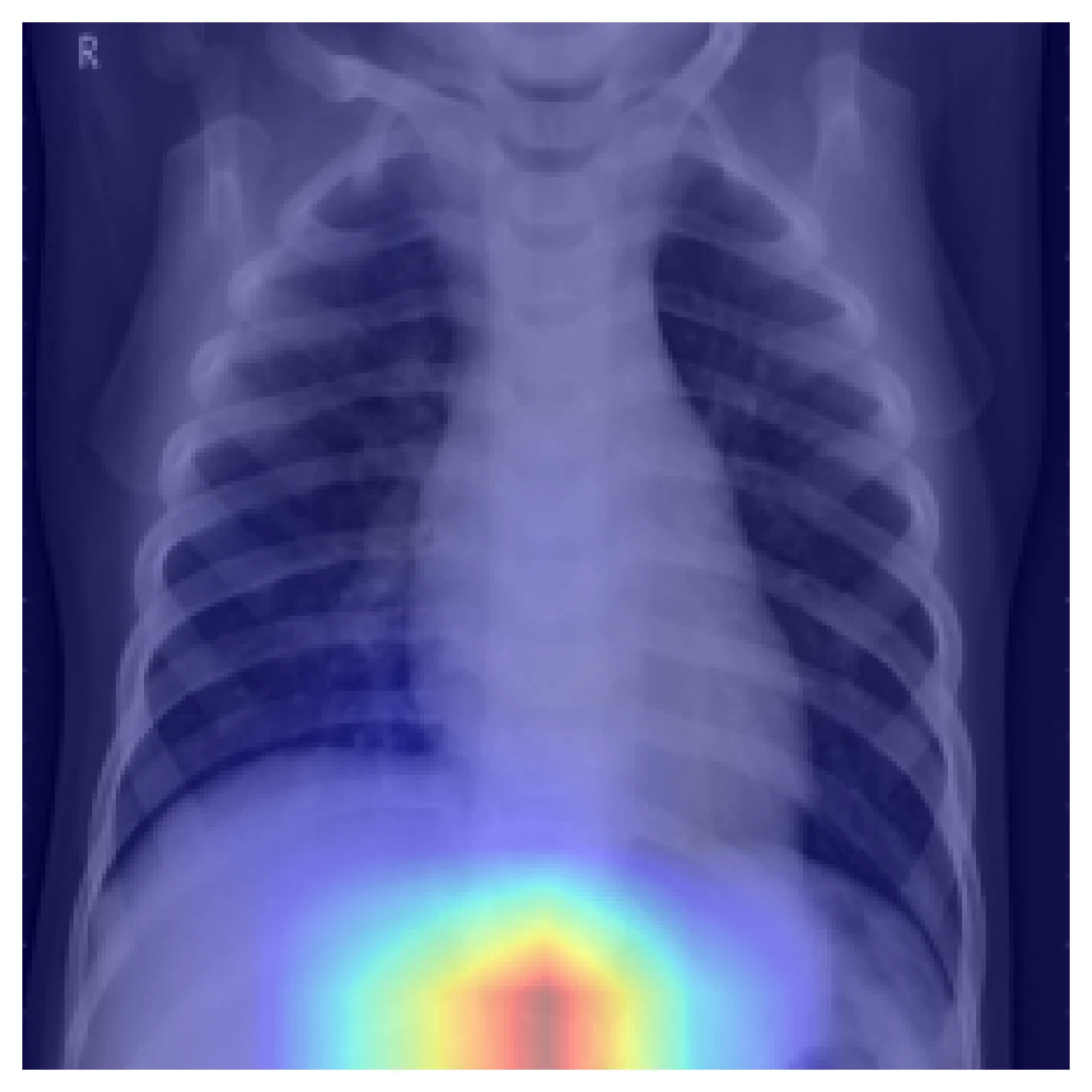 Grad-CAM overlay on a chest X-ray where the heatmap is concentrated below the lung field, on the upper abdomen and diaphragm region.
