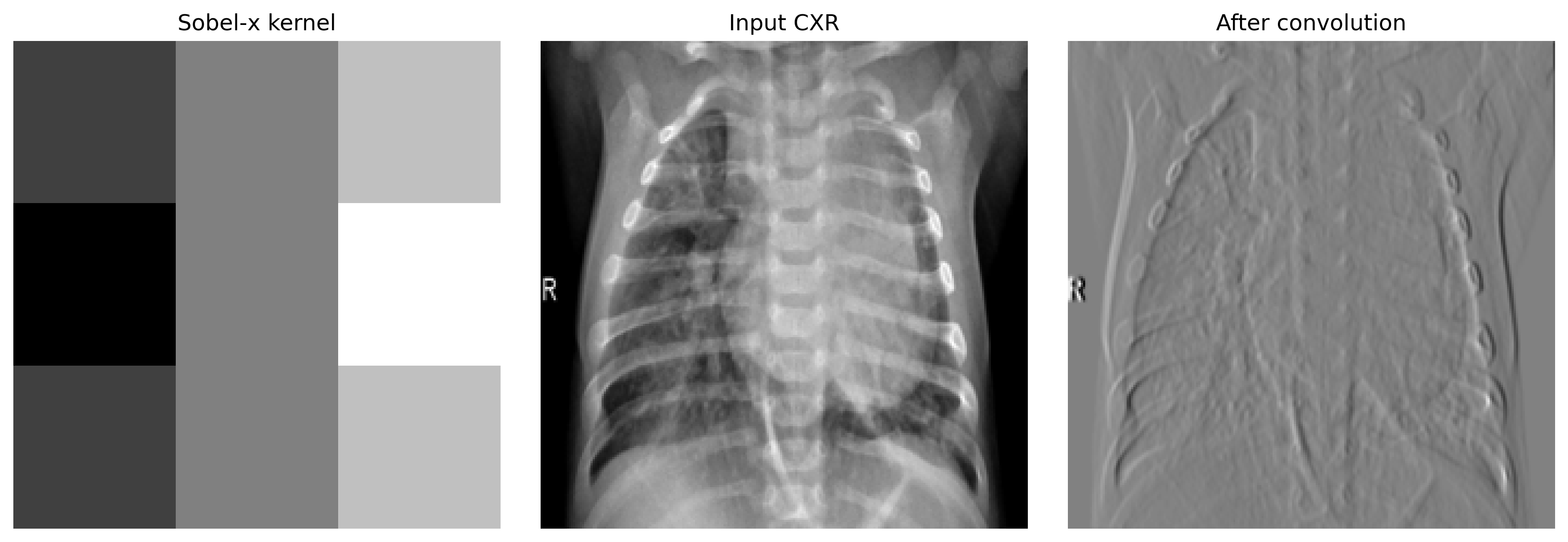 A 3x3 Sobel-x kernel (left) applied to a pediatric chest X-ray (center), producing an output (right) with strong response on vertical edges including ribs, mediastinum, and the side marker.