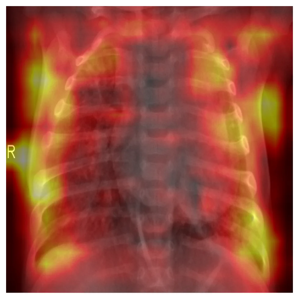Heatmap of the channel-mean activation at ResNet50 C5 (stride 32) overlaid on a chest X-ray. The heatmap is low-resolution and concentrated on the lateral chest wall regions.