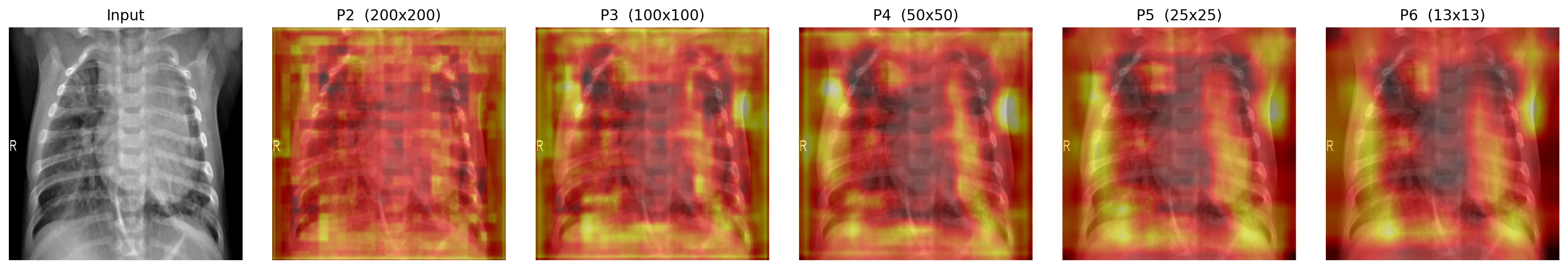 Side-by-side: input chest X-ray followed by FPN feature heatmaps at P2 (200x200), P3 (100x100), P4 (50x50), P5 (25x25), P6 (13x13).