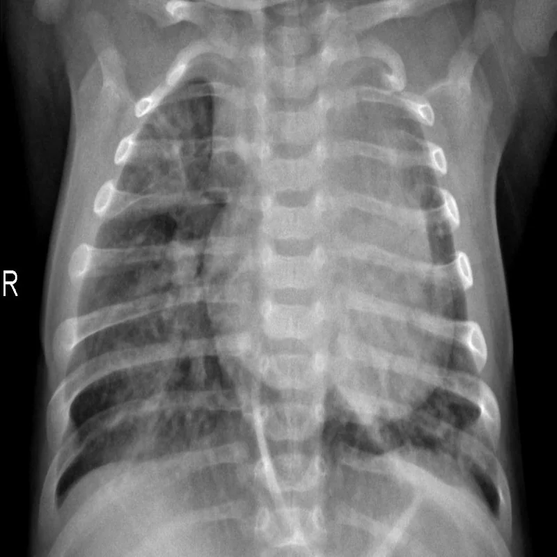 Pediatric chest X-ray showing lower-zone consolidation, used as the canonical input for the FPN visualizations.