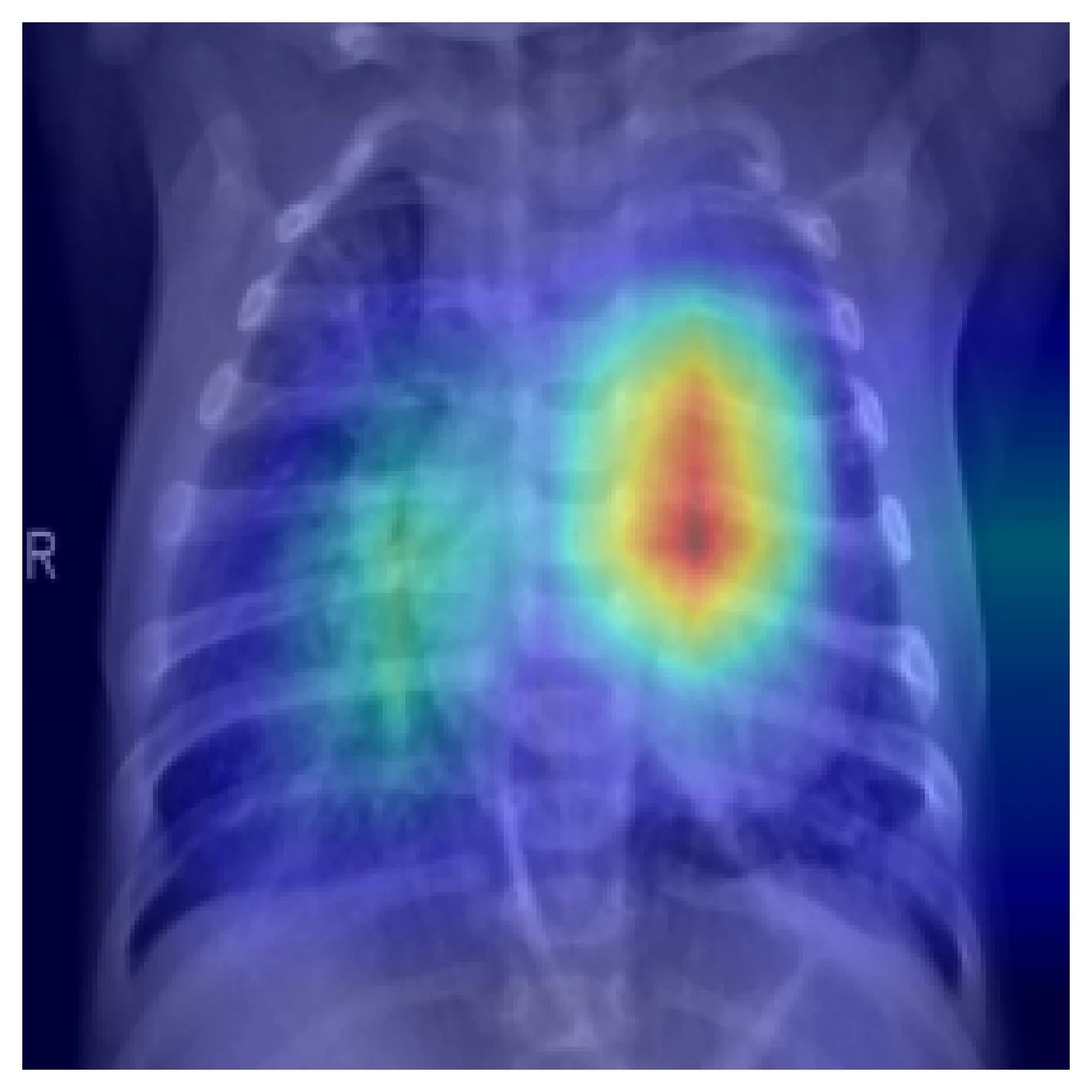 Grad-CAM heatmap overlaid on a pediatric chest X-ray, with strong activation concentrated over consolidated lung tissue on one side of the chest.